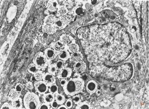 F,31y. | ovary - mucinous carcinoma